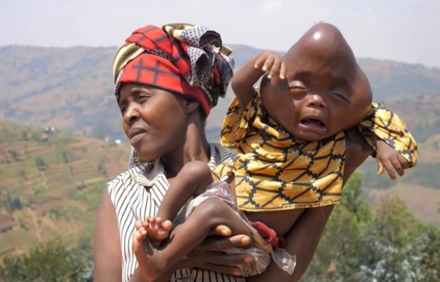 Ռուանդայում դեֆորմացված գանգով երեխա է ծնվել