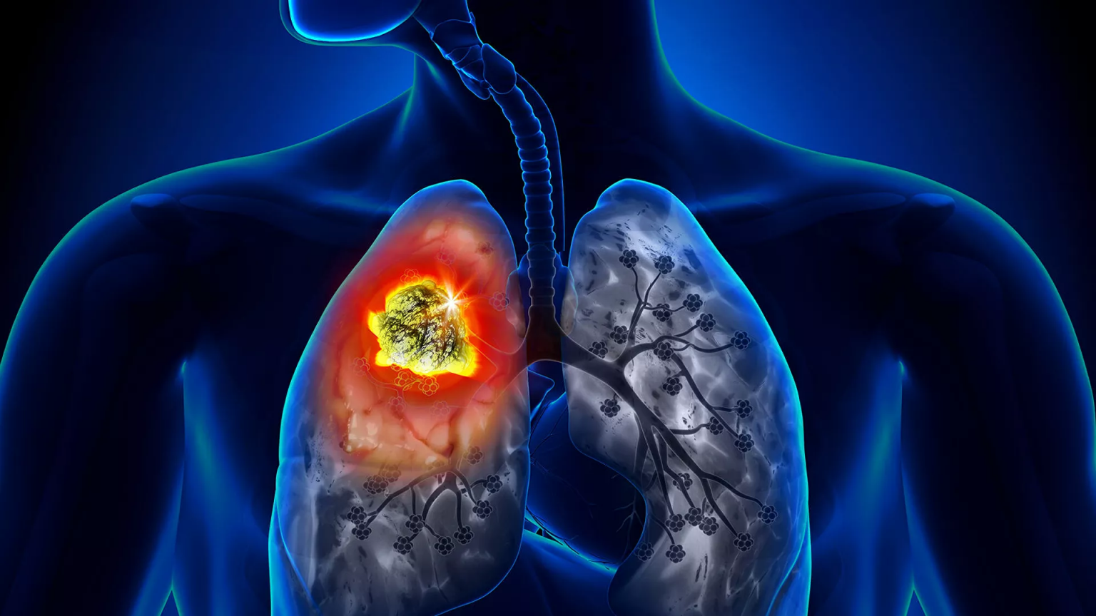 Ինչպե՞ս է թոքերի քաղցկեղն արտահայտվում մարմնի տարբեր մասերում