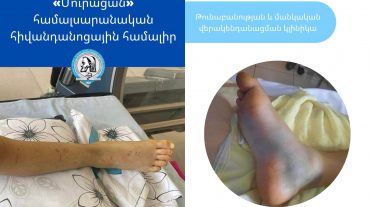 Բազմաղբյուրում օձը երկու տեղով խայթել է 12-ամյա երեխայի
