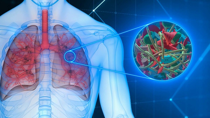 Ինչպե՞ս են միկրոպլաստիկները  մտնում մեր մարմին և առաջացնում քաղցկեղ