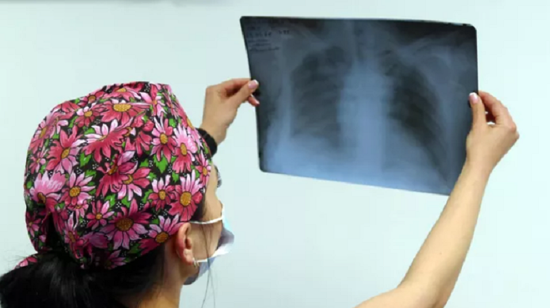 Նովոսիբիրսկում բժիշկները փրկել են թոքերի 100% ախտահարմամբ կնոջ կյանքը