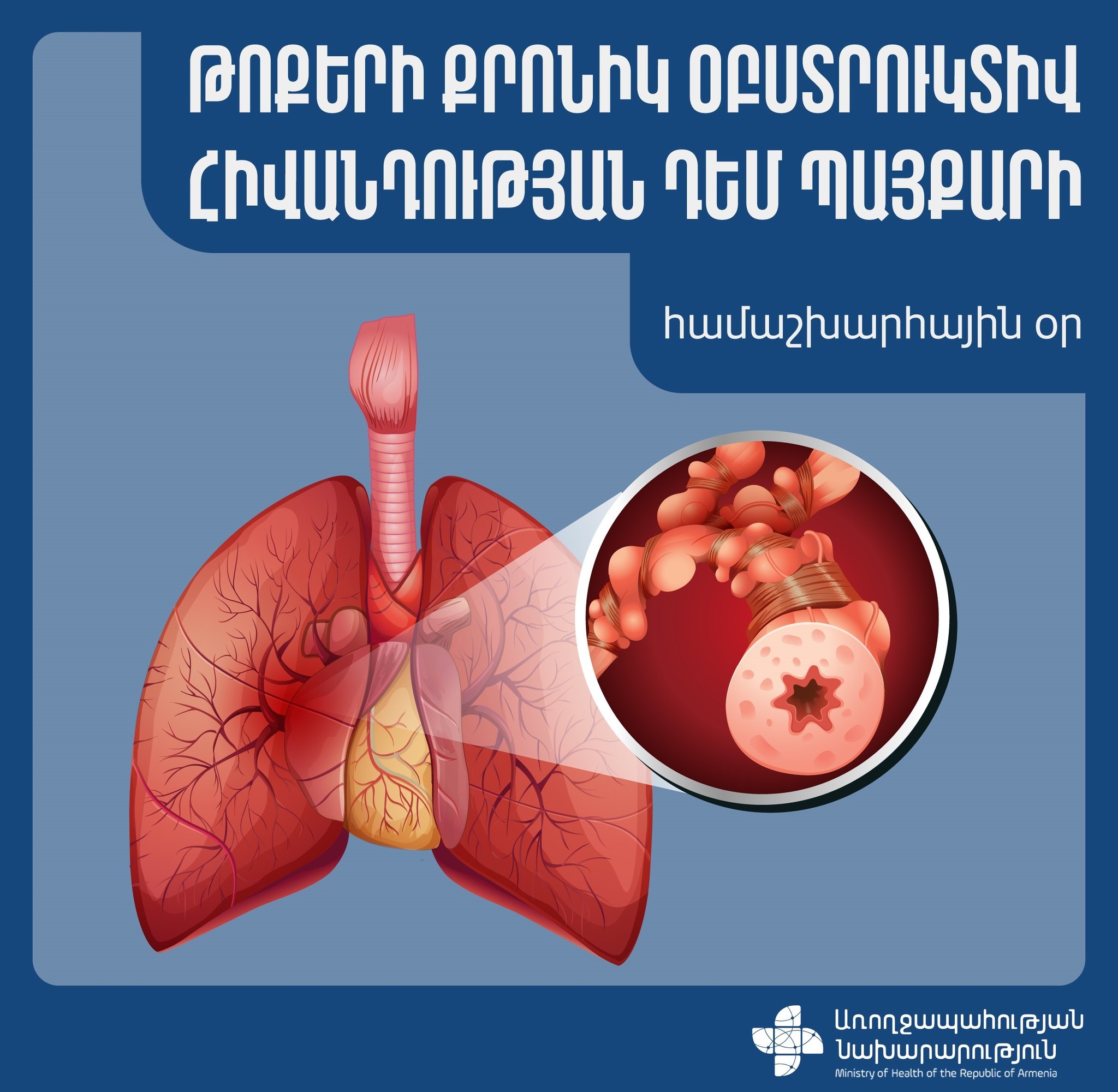 Որո՞նք են թոքերի քրոնիկ օբստրուկտիվ խանգարման ախտանիշները. այսօր հիվանդության դեմ պայքարի համաշխարհային օրն է