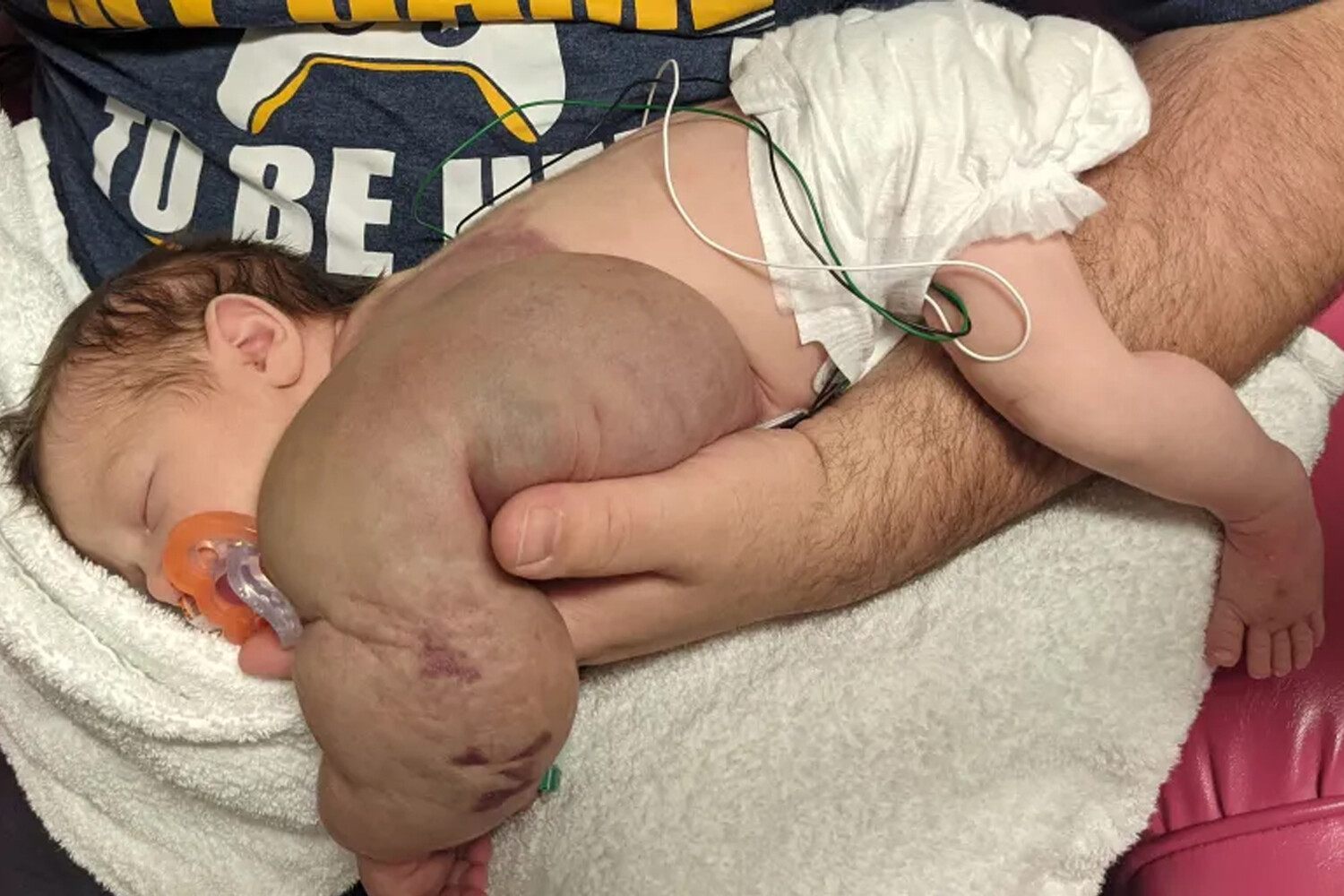 Բժիշկները փրկել են նորածին աղջկան, որի ձեռքին արքայախնձորի չափ ուռուցք է եղել
