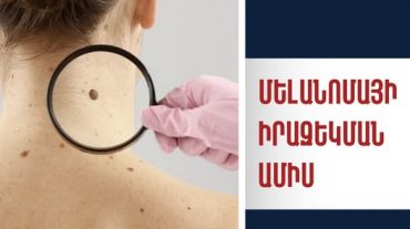 Մայիսը՝ Մելանոմայի իրազեկման ամիս